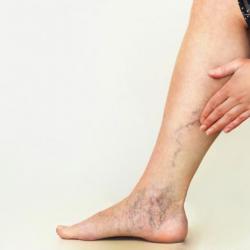 Varicose Vein Doctors – How to Find the Right one?