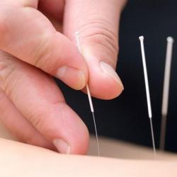 Getting the Best Acupuncture from This Vancouver Acupuncture Clinic