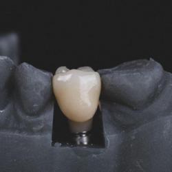 Uncovering the Benefits of Anesthesia for Successful Dental Implant Procedures